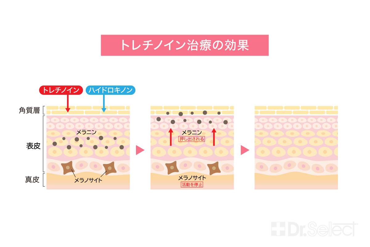 トレチノイン治療の効果について説明図