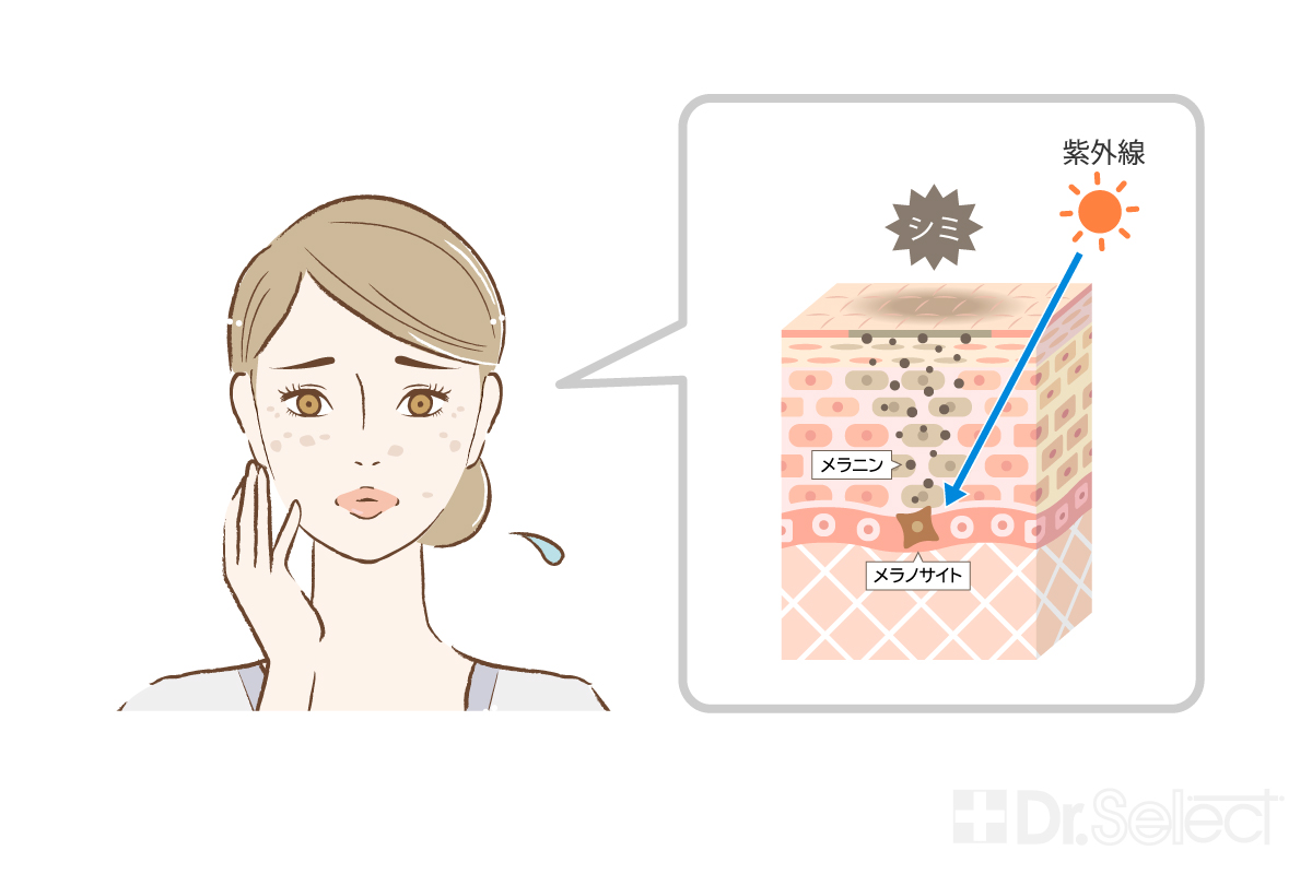 紫外線によるシミの発生を表した図